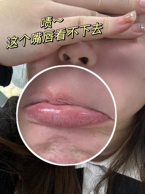 嘴干起皮是什么原因