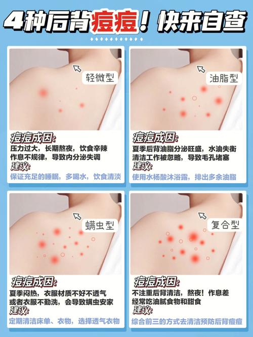 身上长痘痘是什么病
