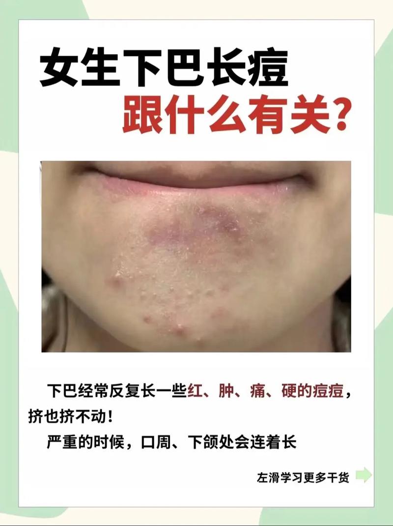 下巴长痘痘是为什么