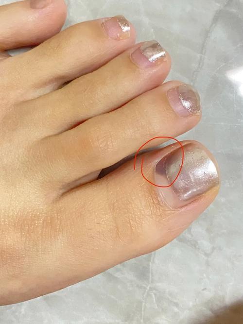 什么样是灰指甲