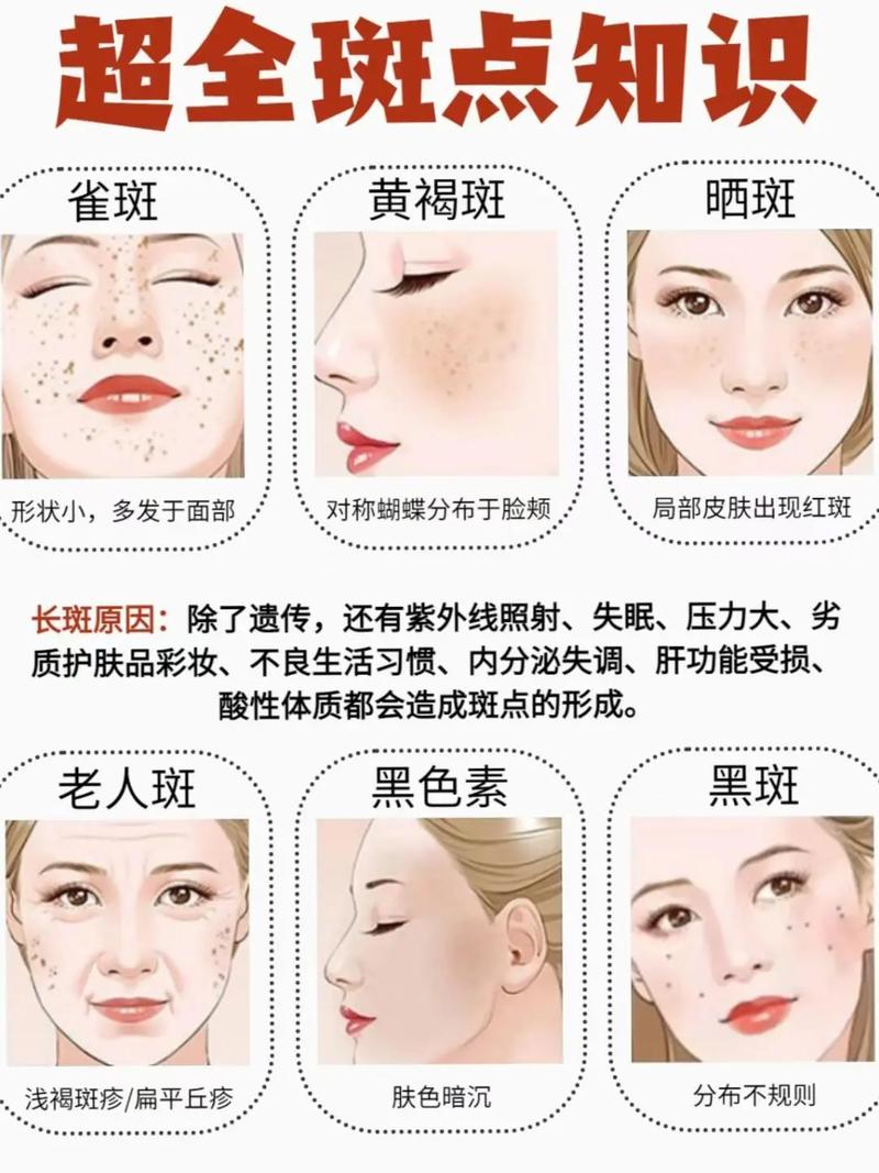 脸上为什么会长雀斑