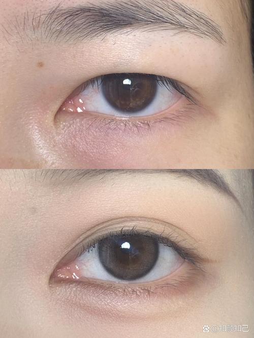 什么是肿泡眼