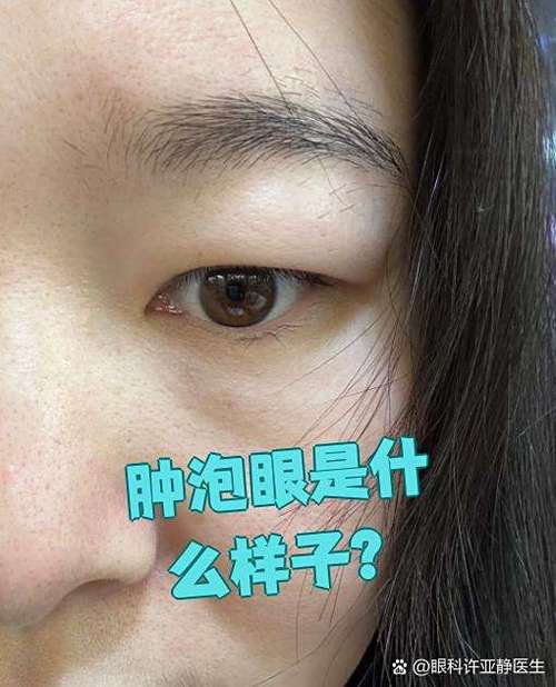 什么是肿泡眼