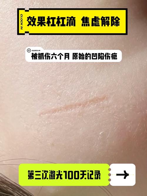 什么的伤疤