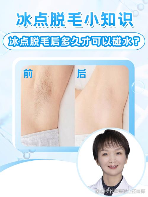 冰点脱毛什么原理