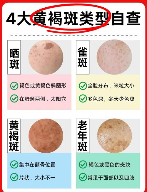 什么去黄褐斑效果好