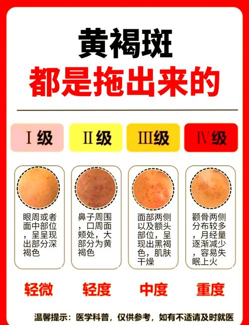 什么去黄褐斑效果好