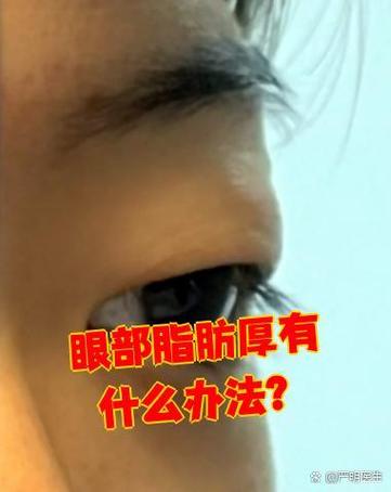 眼皮厚是什么原因