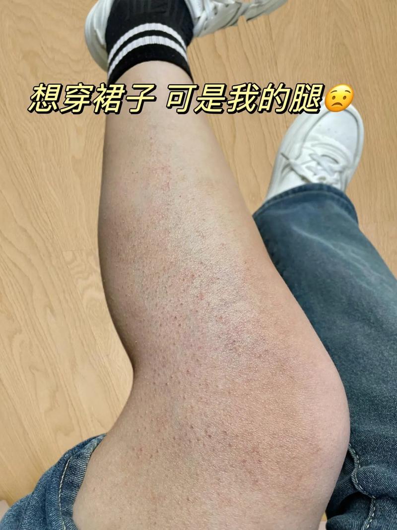 鸡皮肤是什么意思
