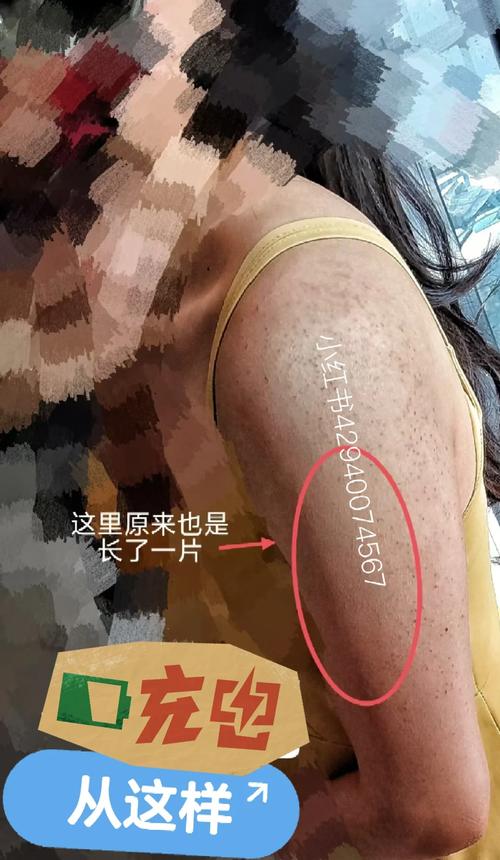 鸡皮肤是什么意思