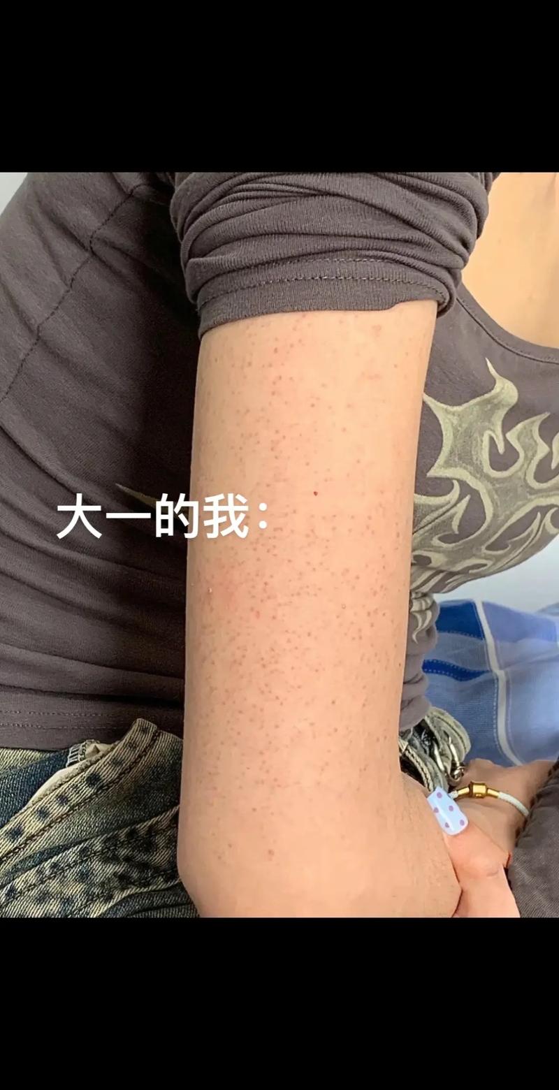 鸡皮肤是什么意思