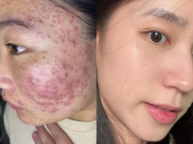 什么去痘痘效果最好