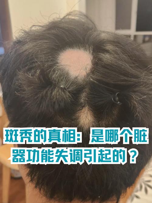 为什么会出现斑秃