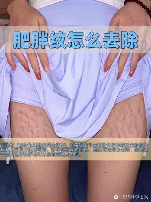 什么能去妊娠纹