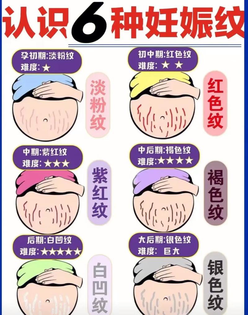 什么能去妊娠纹