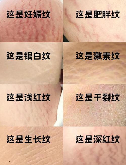 什么能去妊娠纹