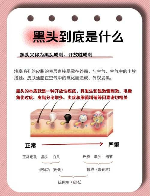 黑头到底是什么