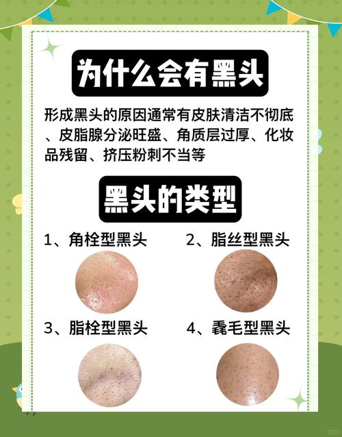 黑头到底是什么