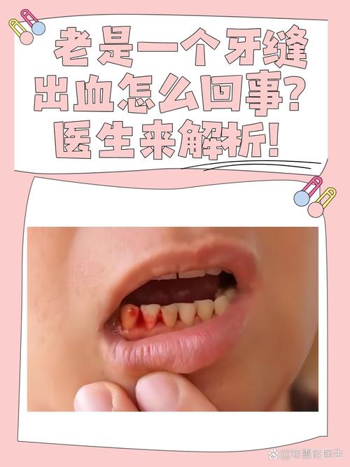 什么病会牙龈出血