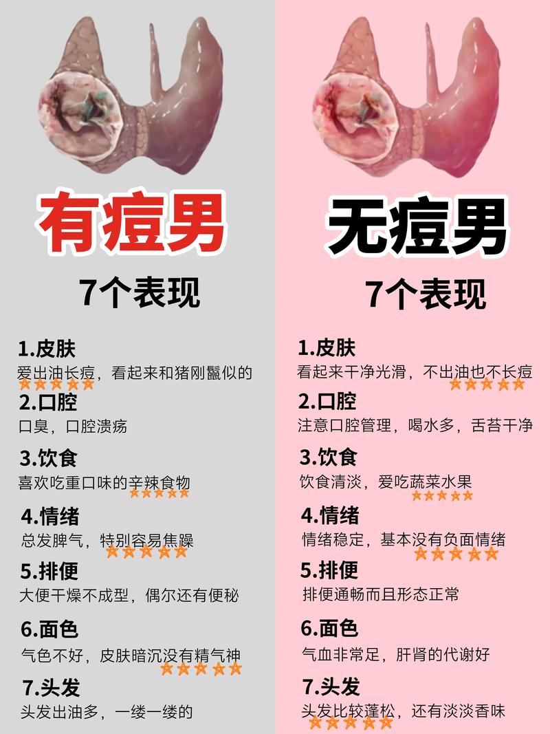 男的长痘痘什么原因