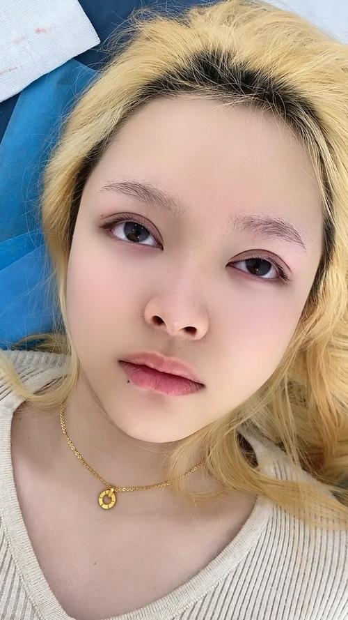 韩式双眼皮是什么