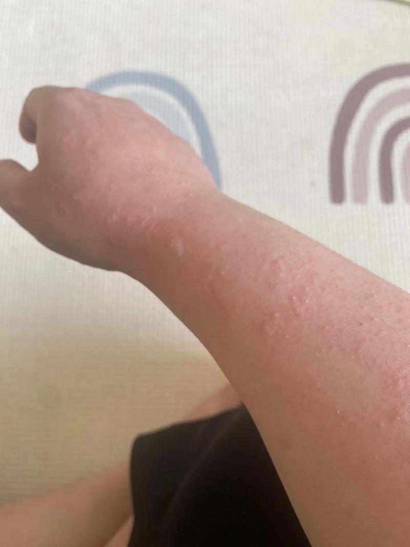 紫外线过敏什么样