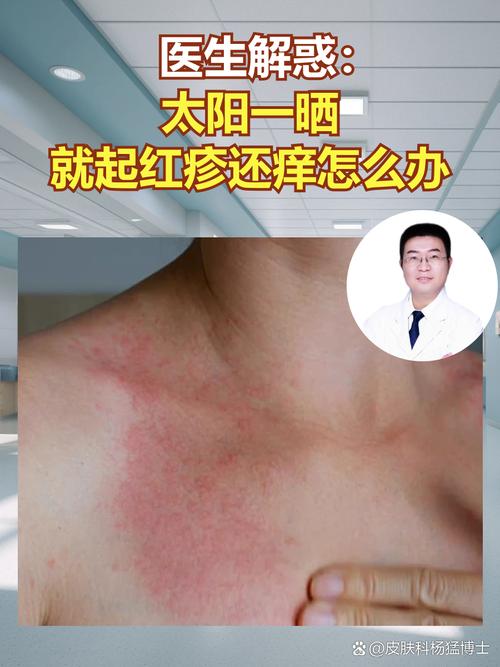 紫外线过敏什么样