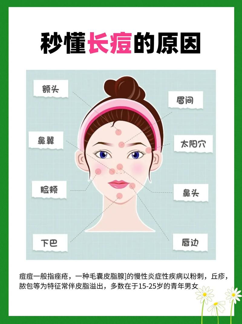 为什么脸颊会长痘痘