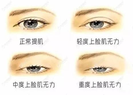 提肌无力是什么