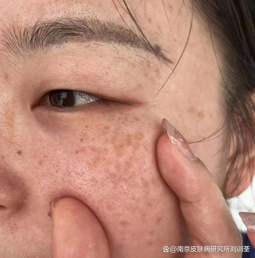 为什么会有晒斑