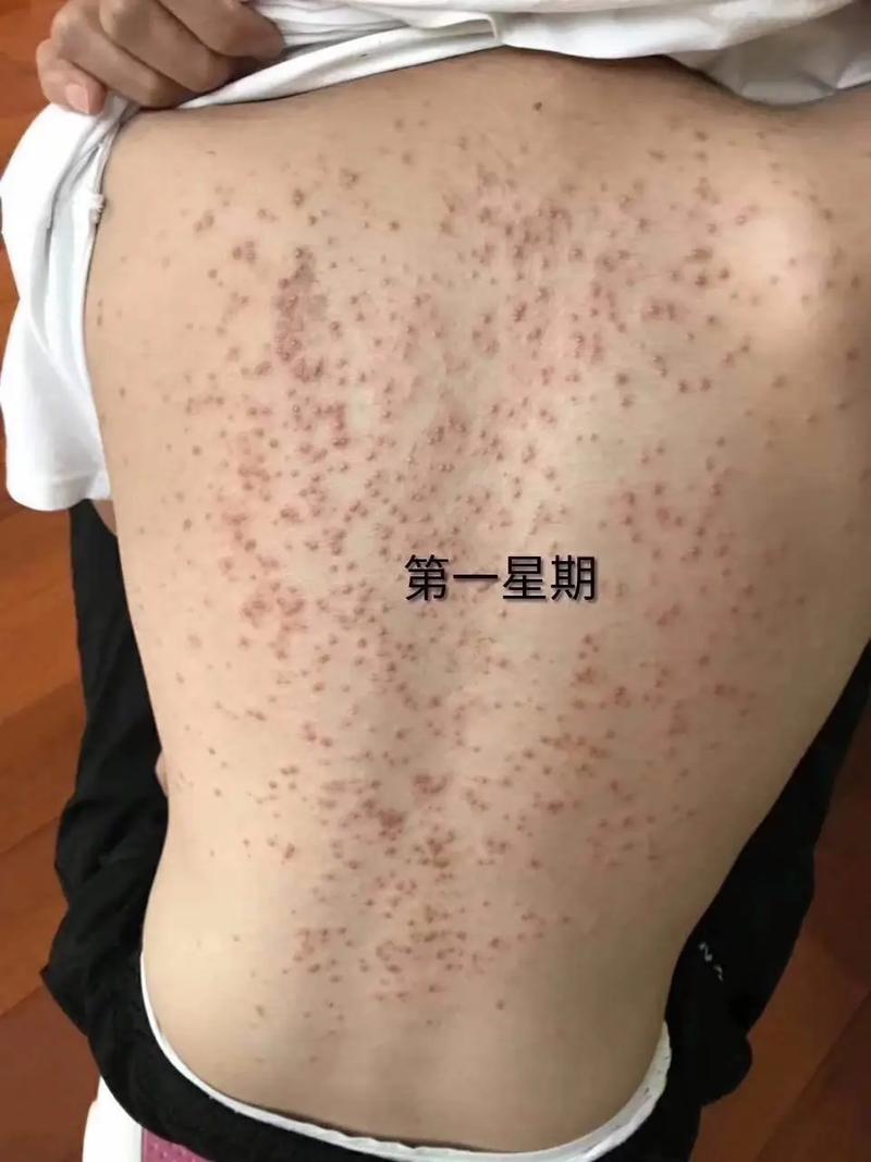 背上起痘痘什么原因