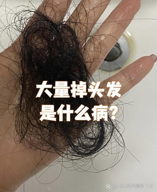 掉发严重是什么病
