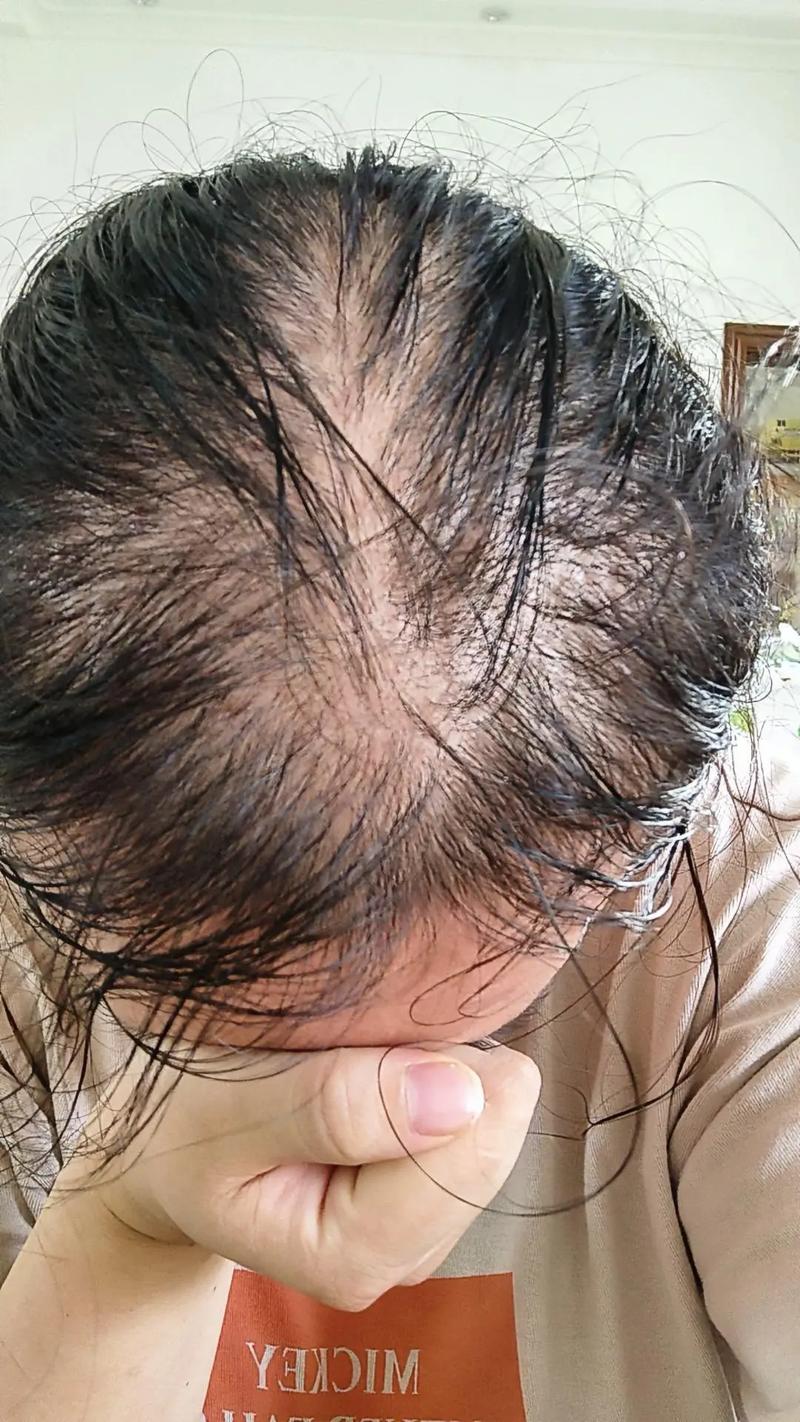 掉发严重是什么病