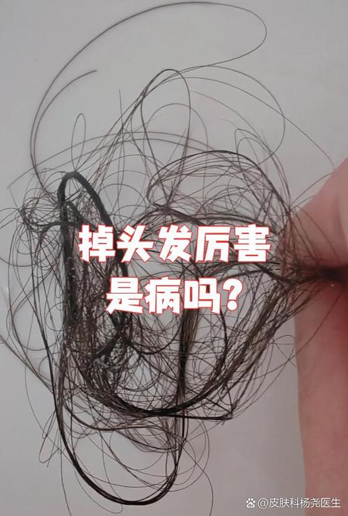 掉发严重是什么病