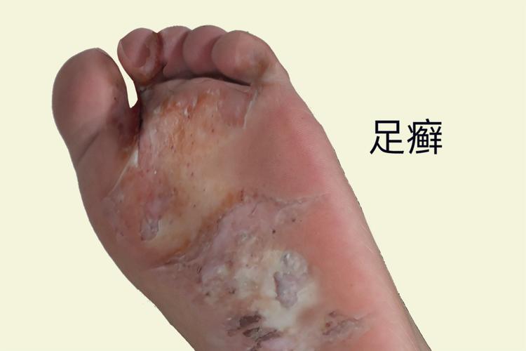 脚气会引起什么病