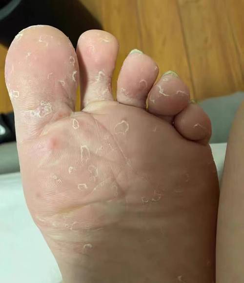 脚气会引起什么病