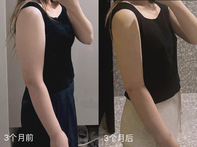 什么吸脂减肥最好