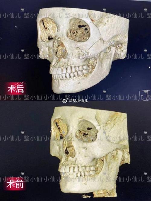 颧骨内推是什么