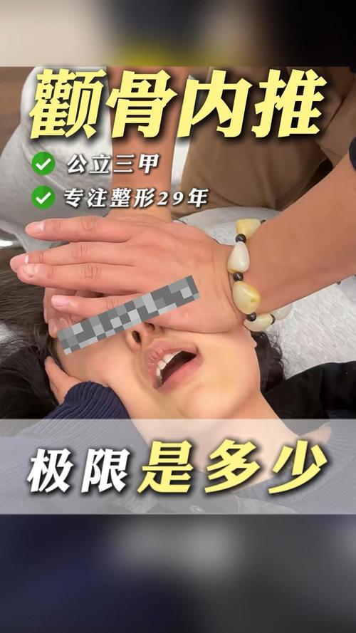 颧骨内推是什么