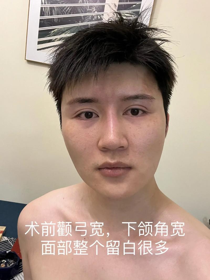 颧骨内推是什么