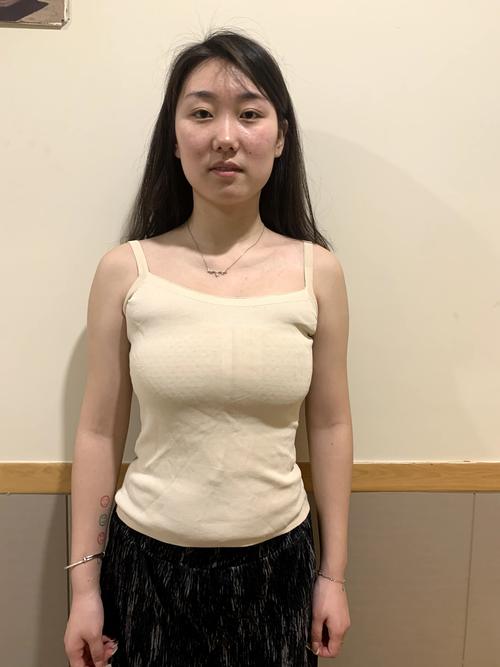 什么是假体丰胸