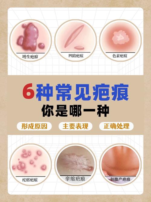 增生性疤痕是什么