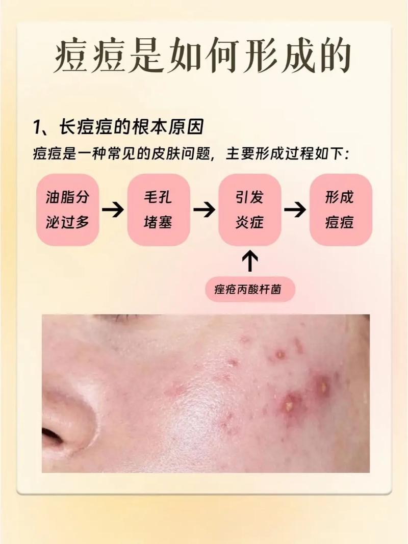 痘痘为什么长在脸上