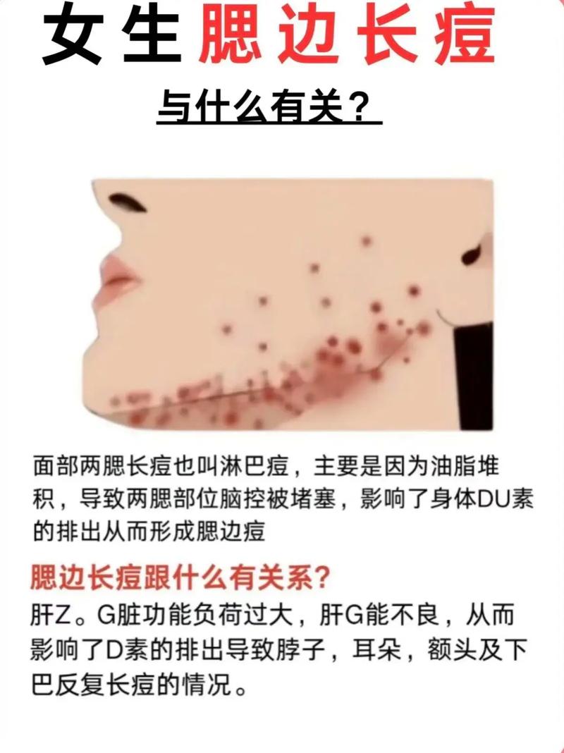 痘痘为什么长在脸上