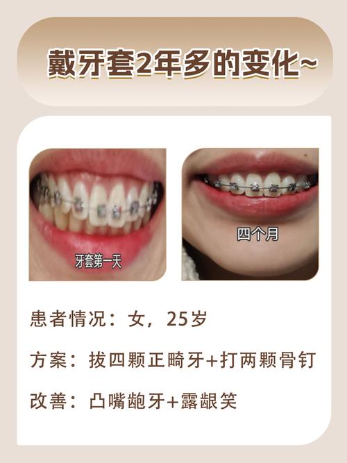 什么情况需要戴牙套