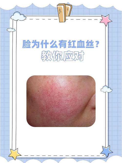 为什么脸上有红血丝