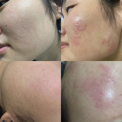 为什么脸上有红血丝
