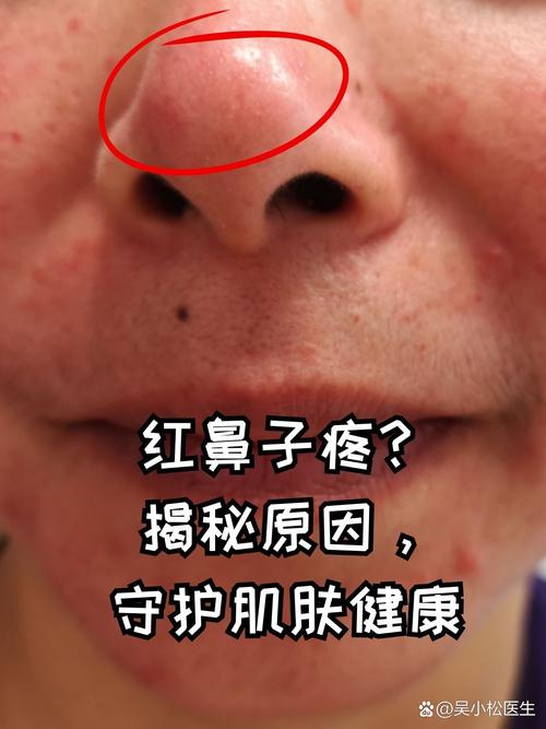 鼻头红肿是什么原因