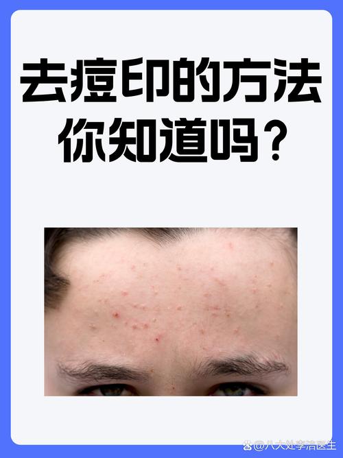 有什么办法去痘印