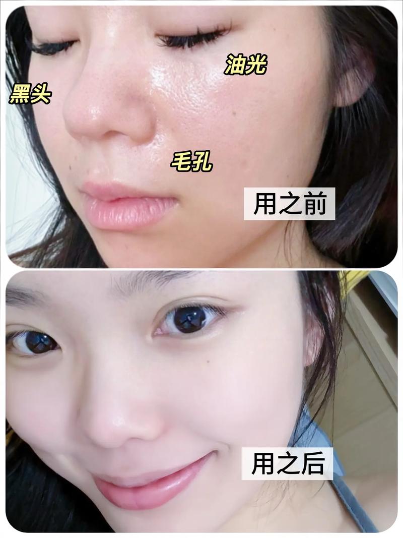 用洗面奶脸上起痘痘怎么回事